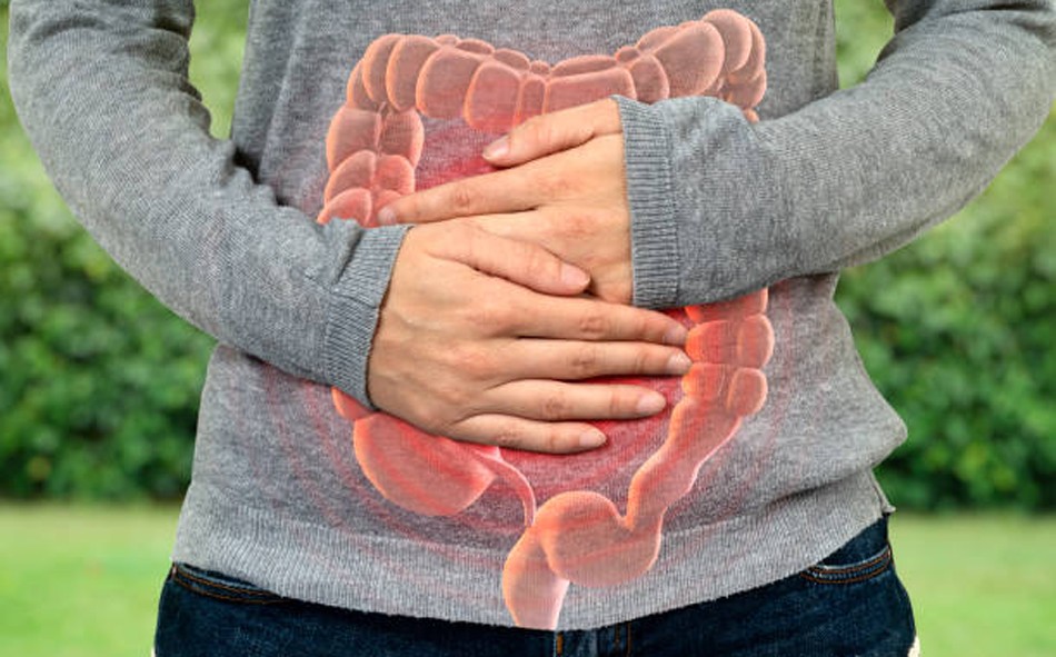 Irritable Bowel Syndrome
